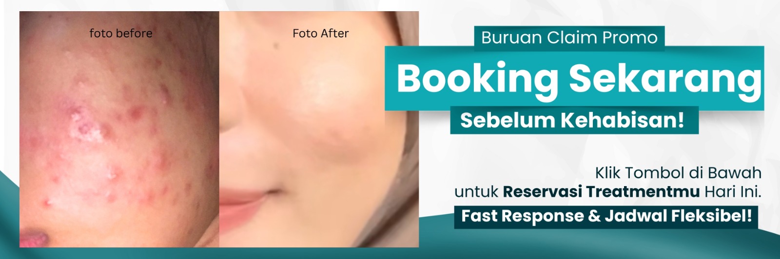 Before After Skin Quality Acne Treatment