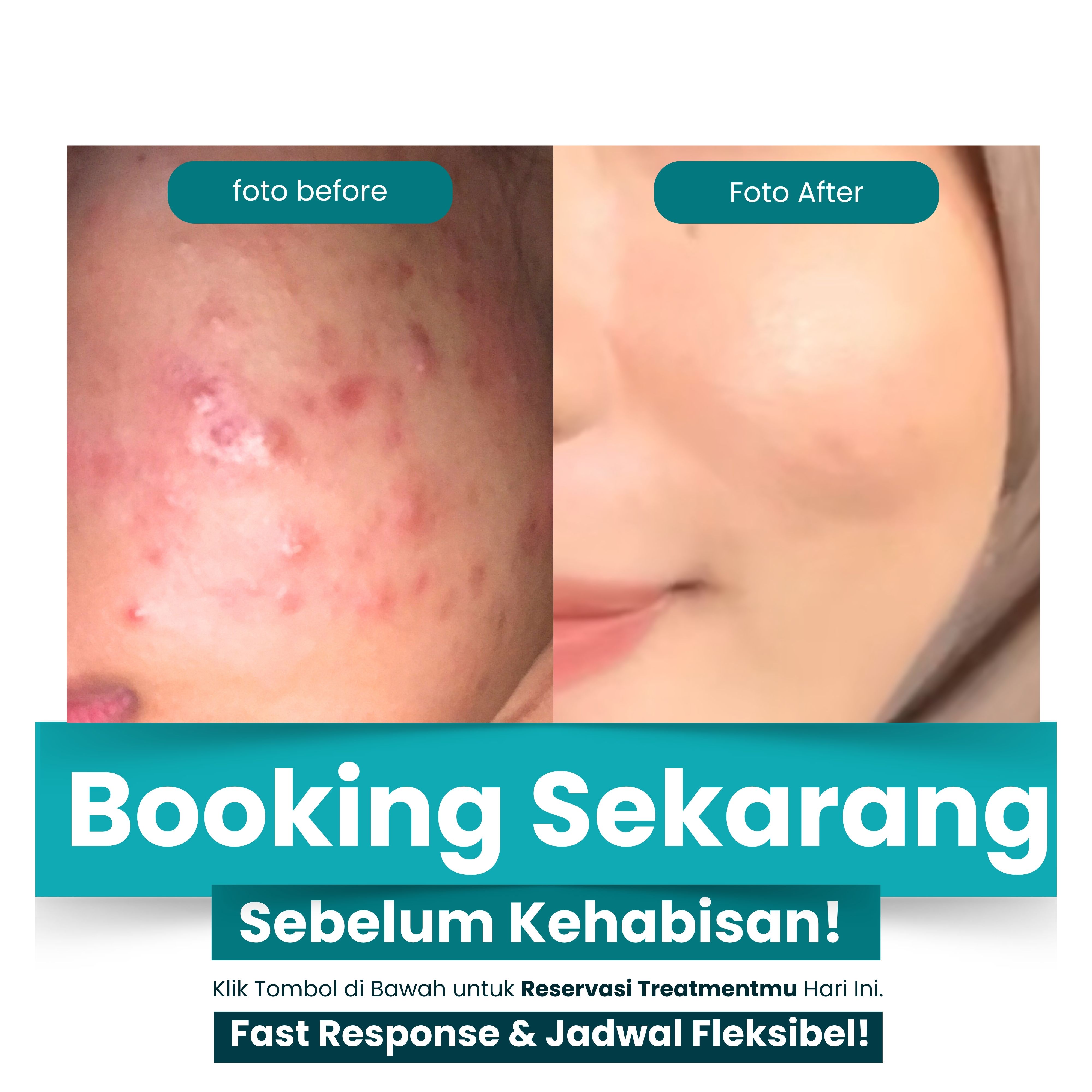 Before After Skin Quality Acne Treatment