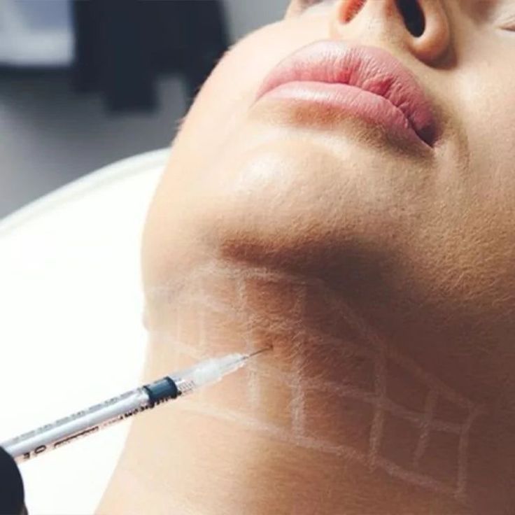 Slimming Injection – Double Chin