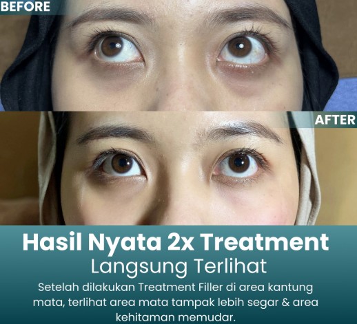 Filler Kantung Mata