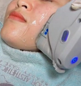 HIFU For Cheek