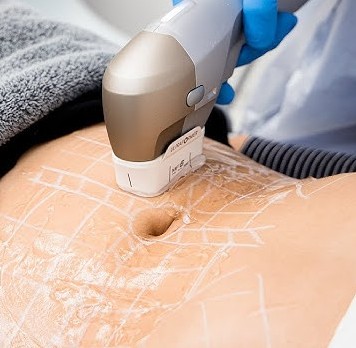 HIFU Body Part