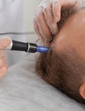 PRP Hair Loss Dermapen