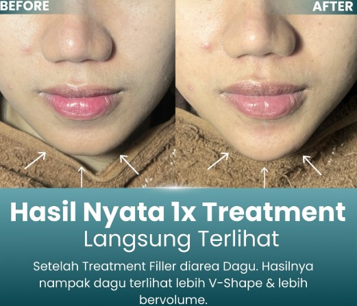 Filler Dagu