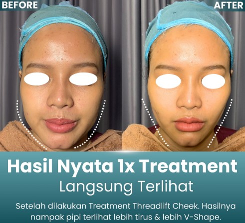 V – Shape Threadlift / Tarik Benang Pipi