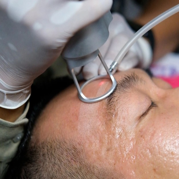 Laser CO2 Fractional