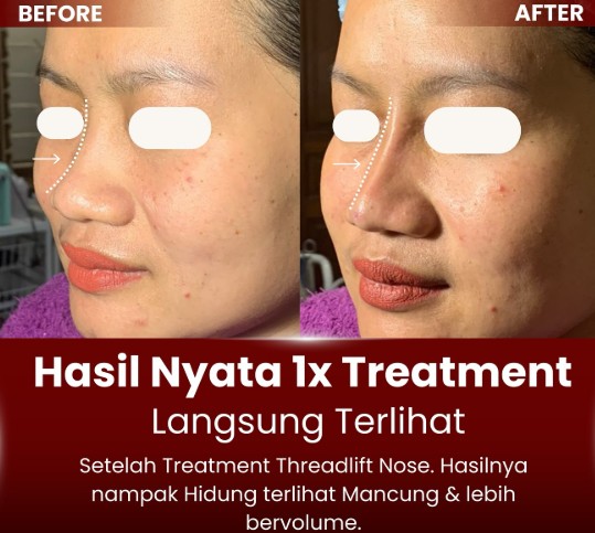 Nose Threadlift / Tanam Benang Hidung