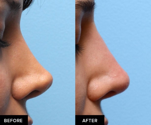 Filler Hidung