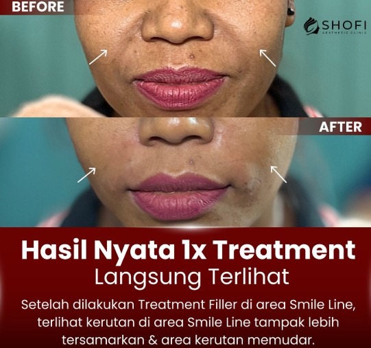 Filler Smile Line