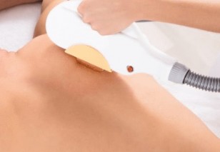 IPL OPT Big Area (Tangan / Kaki / Punggung)